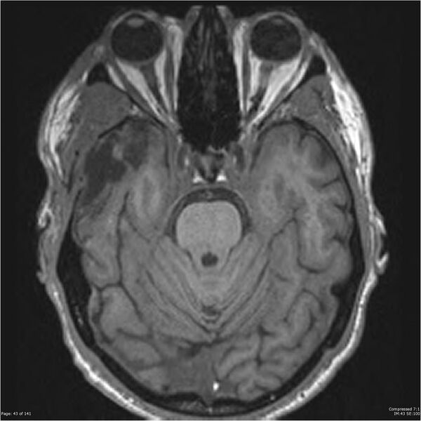 File:Anaplastic meningioma with recurrence (Radiopaedia 34452-35788 Axial T1 41).jpg