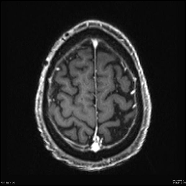 File:Anaplastic meningioma with recurrence (Radiopaedia 34452-35788 Axial T1 C+ 126).jpg