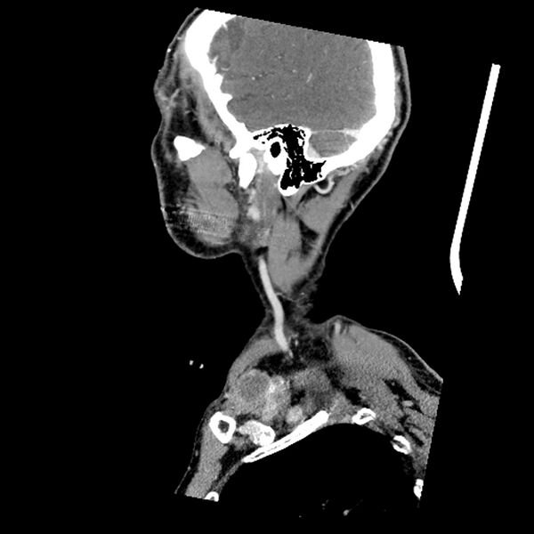File:Anaplastic thyroid carcinoma (Radiopaedia 79087-92034 C 19).jpg