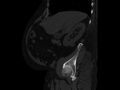 Ankylosing spondylitis (Radiopaedia 44609-48357 Sagittal bone window 24).jpg