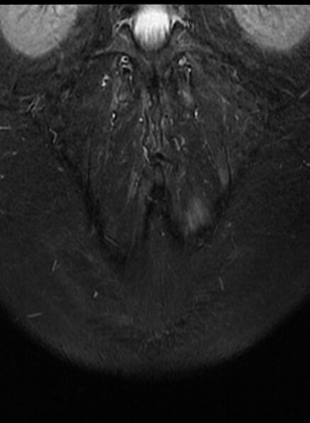 File:Ankylosing spondylitis - Andersson lesion (Radiopaedia 81878-95838 Coronal STIR 14).jpg