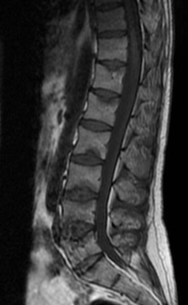 File:Ankylosing spondylitis - Andersson lesion (Radiopaedia 81878-95838 Sagittal T1 7).jpg