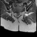 Ano-vaginal fistula (Radiopaedia 29765-30284 Coronal T1 C+ 19).jpg