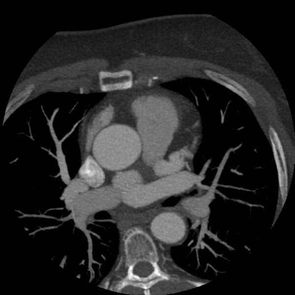 File:Anomalous origin of left circumflex artery from right coronary sinus (Radiopaedia 72563-83117 A 48).jpg