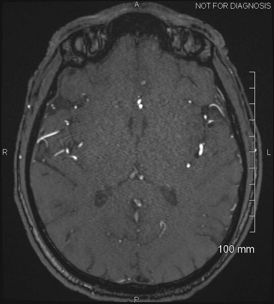 File:Anterior cerebral artery aneurysm (Radiopaedia 80683-94127 Axial MRA 132).jpg