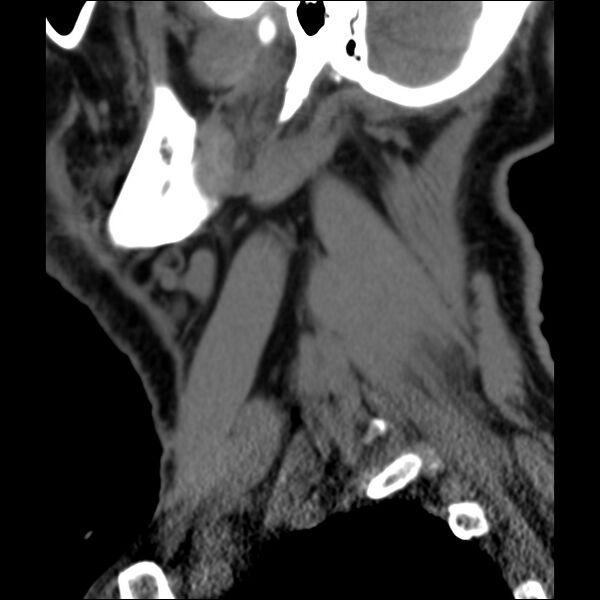 File:Anterior cervical postdiscectomy arthrodesis (Radiopaedia 32678-33646 C 43).jpg