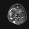 Anterior cruciate ligament tear - pediatric (Radiopaedia 62152-70260 Axial PD fat sat 23).jpg
