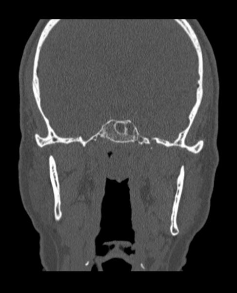 File:Antrochoanal polyp (Radiopaedia 79011-92169 Coronal bone window 8).jpg