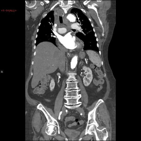 File:Aortic intramural hematoma (Radiopaedia 27746-28001 B 31).jpg