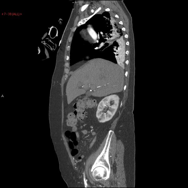 File:Aortic intramural hematoma (Radiopaedia 27746-28001 C 8).jpg