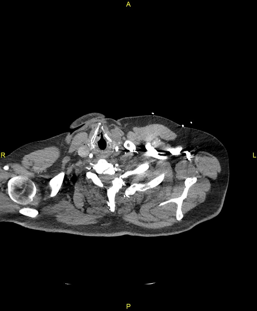 Aortic rupture (Radiopaedia 88822-105594 B 4).jpg