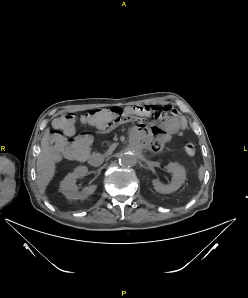 File:Aortoenteric fistula (Radiopaedia 84308-99603 Axial non-contrast 114).jpg