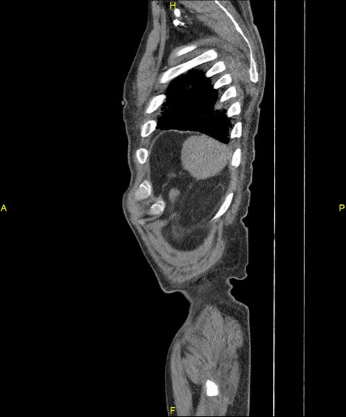File:Aortoenteric fistula (Radiopaedia 84308-99603 C 310).jpg