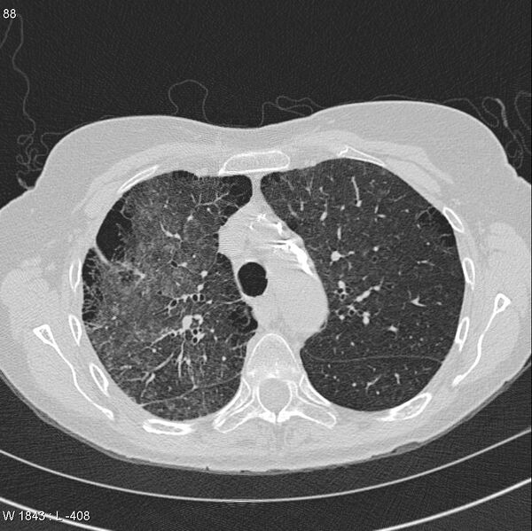 File:Apical non-small-cell lung cancer (Radiopaedia 8570-9405 Axial lung window 14).jpg