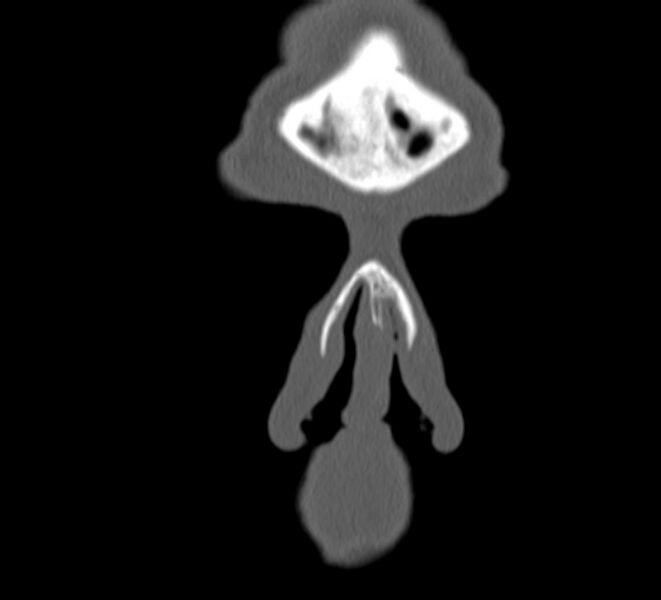 File:Aplastic maxillary sinuses (Radiopaedia 60030-67561 Coronal non-contrast 2).jpg