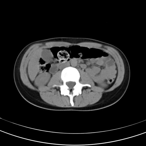File:Appendicitis and incidental bicornuate uterus (Radiopaedia 22833-22853 Axial non-contrast 21).jpg