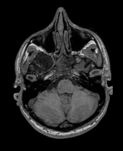 File:Arachnoid cyst- extremely large (Radiopaedia 68741-78451 Axial T1 18).jpg