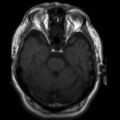 Arachnoid cyst - middle cranial fossa (Radiopaedia 9016-9775 Axial T1 1).jpg