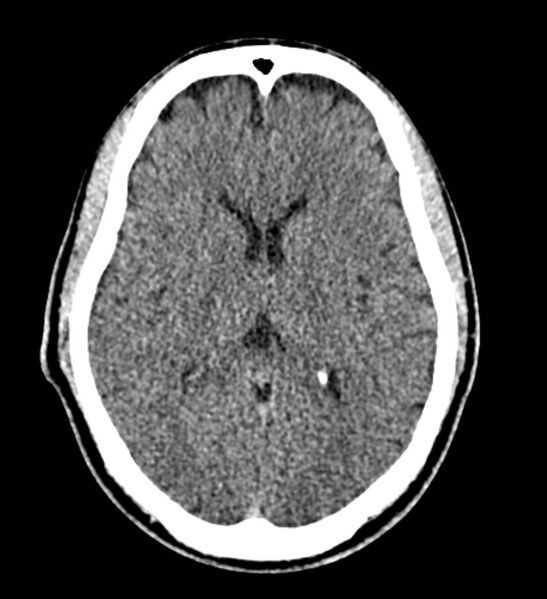 File:Arachnoid cyst of the ambient cistern (Radiopaedia 81301-94986 Axial non-contrast 39).jpg