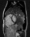 Arrhythmogenic right ventricular cardiomyopathy (Radiopaedia 57972-64966 D 6).jpg