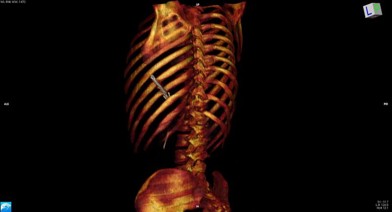 File:Arrow injury to the chest (Radiopaedia 75223-86321 3D bone 17).jpg