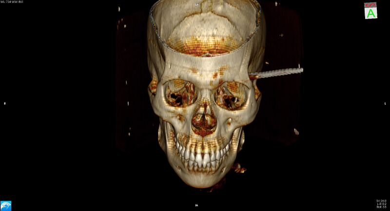 File:Arrow injury to the head (Radiopaedia 75266-86388 3D vertical 7).jpg