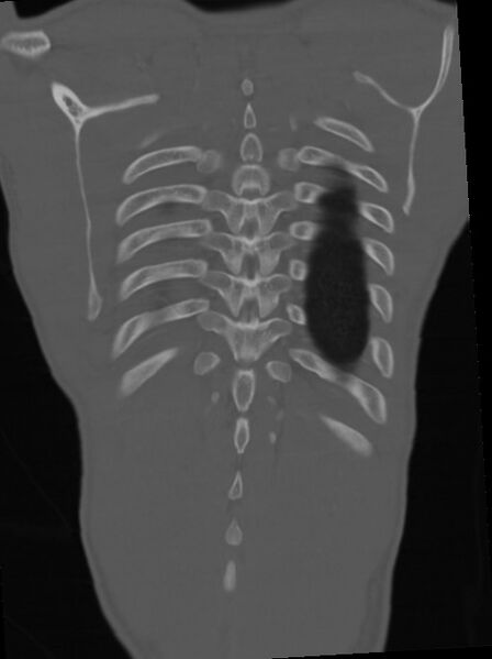 File:Arrow injury to the neck (Radiopaedia 75225-86323 Coronal bone window 102).jpg