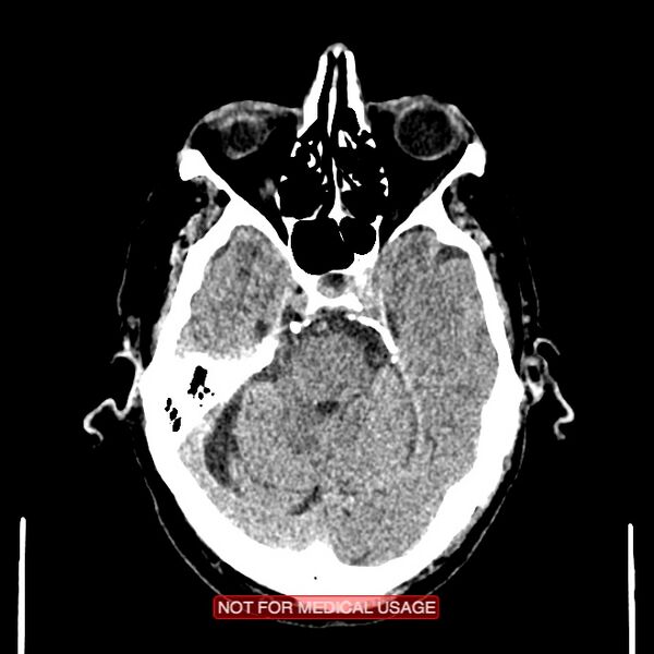 File:Artery of Percheron infarction (Radiopaedia 28679-28967 Axial non-contrast 36).jpg