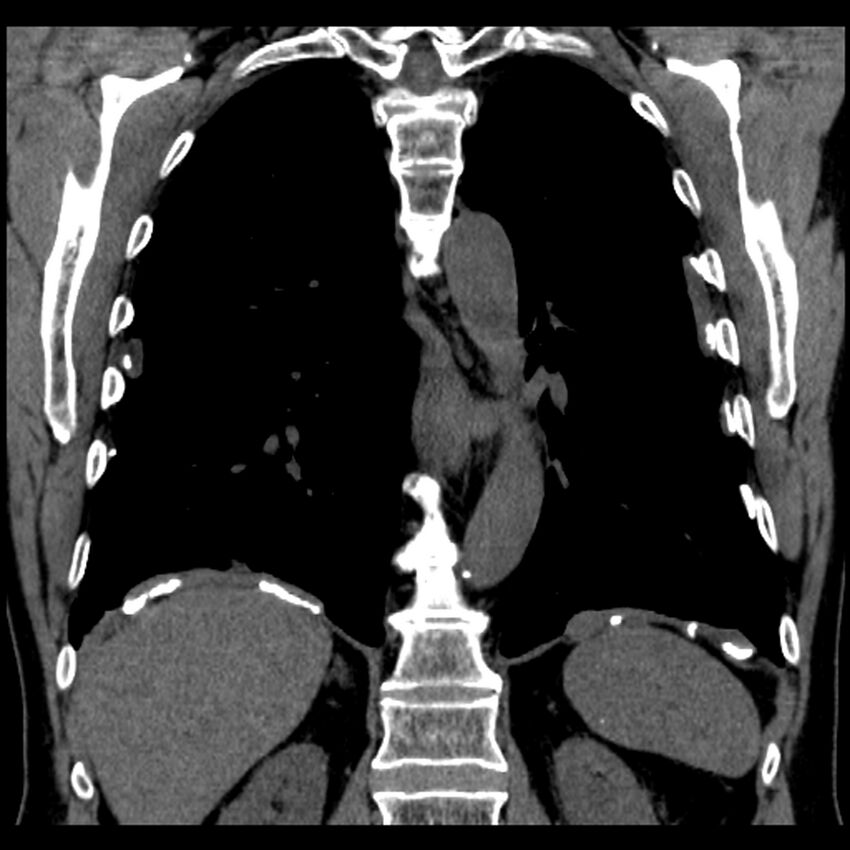 Asbestos-related pleural plaques (Radiopaedia 39069-41255 Coronal non-contrast 29).jpg