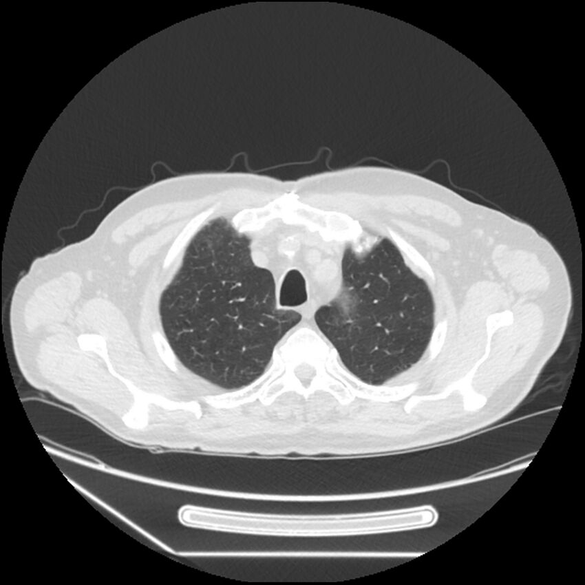 Asbestosis complicated by lung cancer (Radiopaedia 45834-50116 Axial lung window 13).jpg
