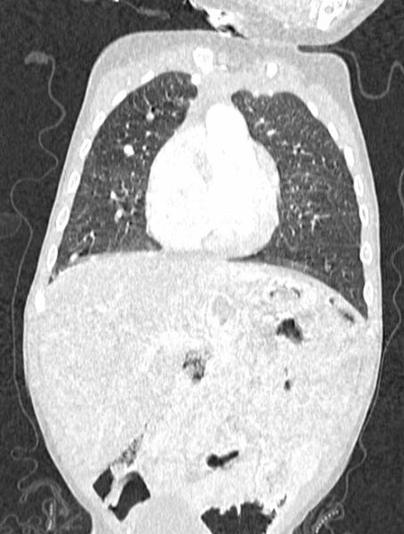 File:Asplenia syndrome (Radiopaedia 73083-83792 Coronal lung window 46).jpg