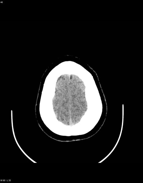 File:Astroblastoma (Radiopaedia 39792-42216 Axial non-contrast 45).jpg