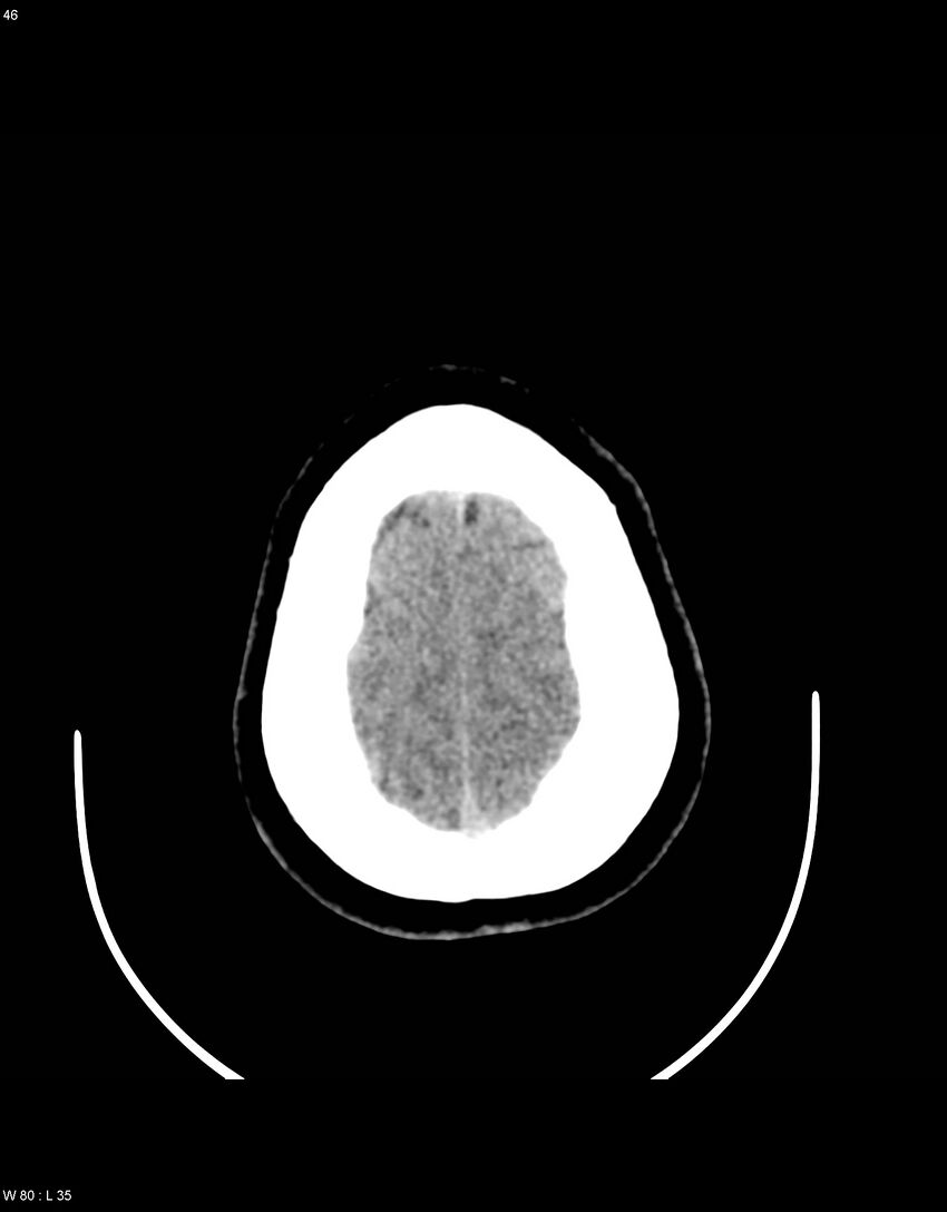 Astroblastoma (Radiopaedia 39792-42216 Axial non-contrast 45).jpg