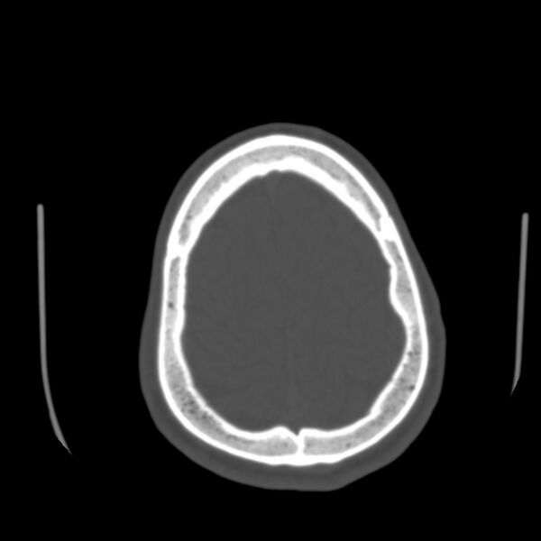 File:Asymptomatic occipital spur (Radiopaedia 87753-104201 Axial bone window 181).jpg