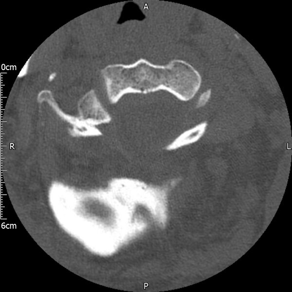File:Atlas fracture with Currarino type A congenital defect (Radiopaedia 71747-82144 Axial bone window 45).jpg