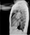 Atrial septal defect with pulmonary hypertension (Radiopaedia 48742-53788 Lateral 1).jpg