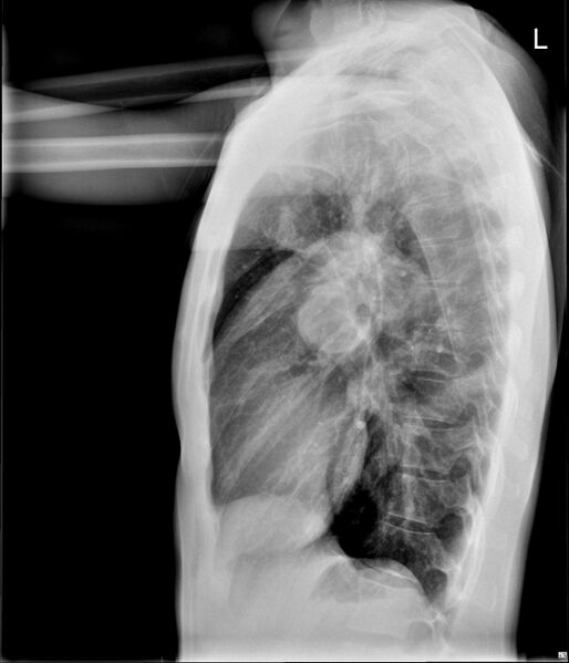 File:Atrial septal defect with pulmonary hypertension (Radiopaedia 48742-53788 Lateral 1).jpg