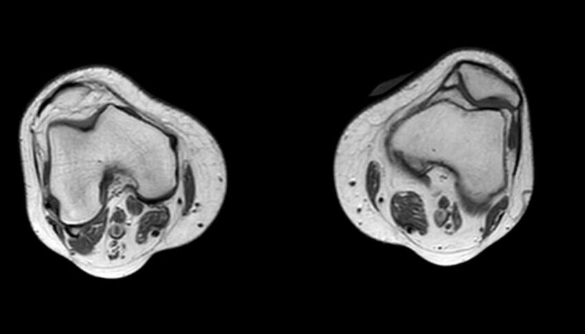 Atypical lipomatous tumor - thigh (Radiopaedia 68975-78734 Axial T1 11).jpg