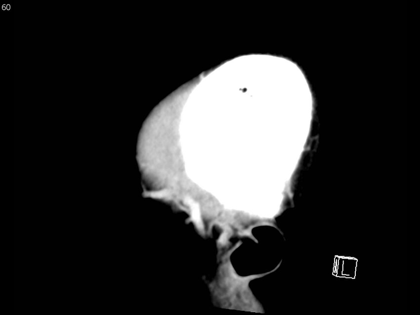 Atypical meningioma - intraosseous (Radiopaedia 64915-73867 F 59).jpg