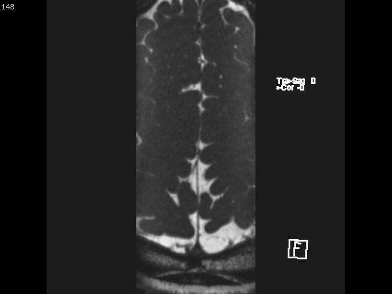 File:Atypical meningioma - intraosseous (Radiopaedia 64915-74572 Axial CISS 148).jpg