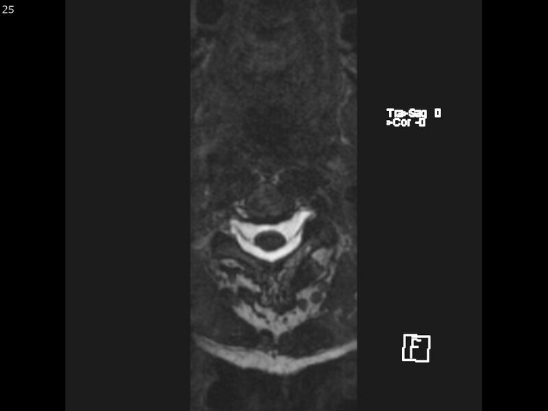 File:Atypical meningioma - intraosseous (Radiopaedia 64915-74572 Axial CISS 25).jpg