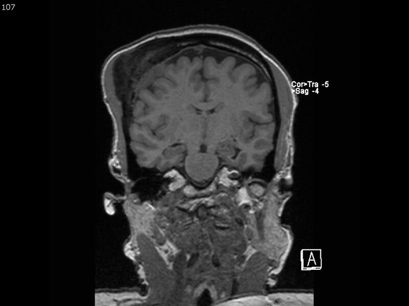 File:Atypical meningioma - intraosseous (Radiopaedia 64915-74572 Coronal T1 107).jpg