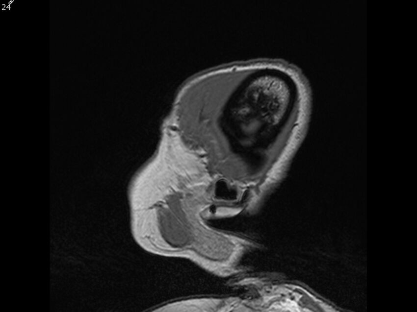 Atypical meningioma - intraosseous (Radiopaedia 64915-74572 Sagittal T1 24).jpg