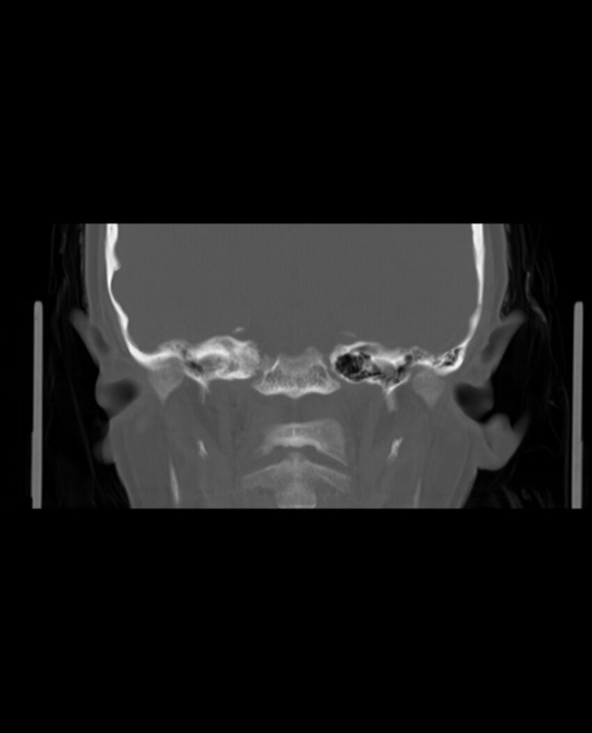 Automastoidectomy with labyrinthine fistula (Radiopaedia 84143-99411 Coronal non-contrast 87).jpg