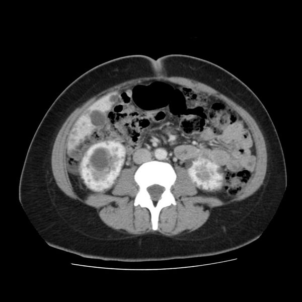 File:Autosomal dominant polycystic kidney disease (Radiopaedia 23061-23093 C 37).jpg