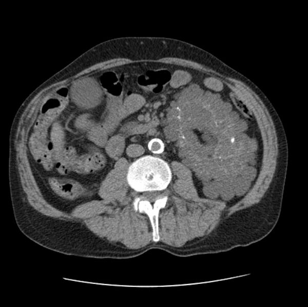 File:Autosomal dominant polycystic kidney disease (Radiopaedia 27851-28094 Axial non-contrast 76).jpg