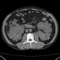 Autosomal dominant polycystic kidney disease (Radiopaedia 36539-38101 Axial non-contrast 41).jpg