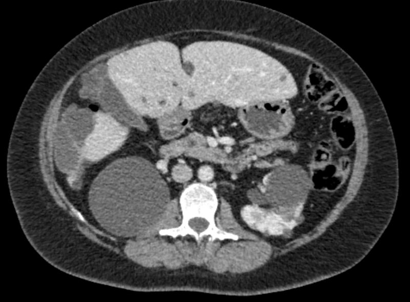 File:Autosomal dominant polycystic kidney disease (Radiopaedia 57124-64017 A 52).jpg