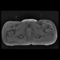 Avascular necrosis of the hip (Radiopaedia 29563-30067 Axial T1 fat sat 15).jpg