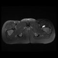 Avascular necrosis of the hip (Radiopaedia 29563-30067 Axial T2 fat sat 15).jpg